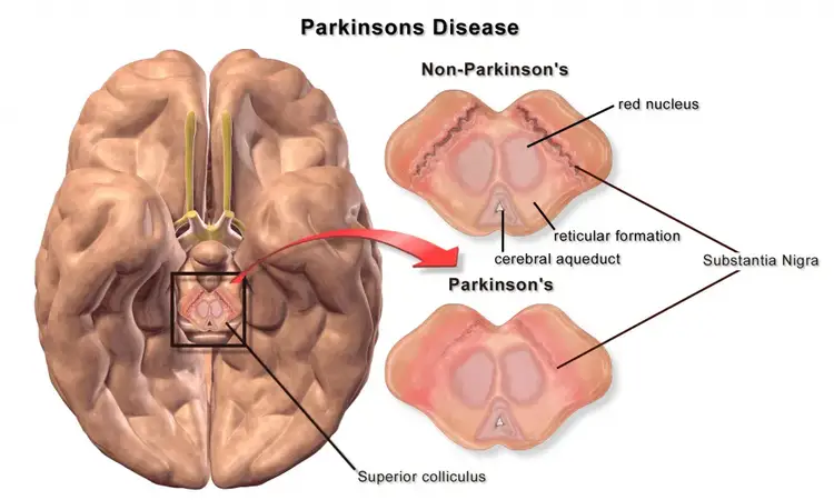 Parkinson's disease